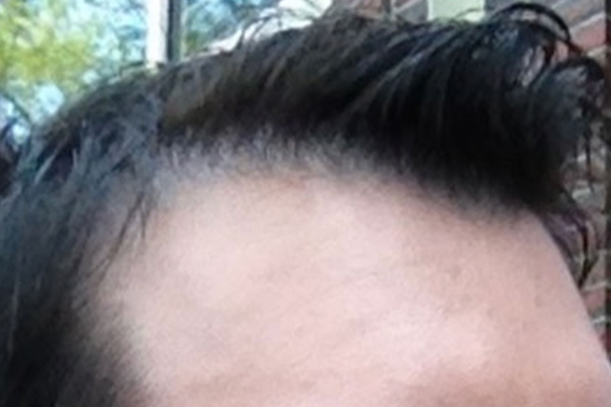 before hair restoration indianapolis